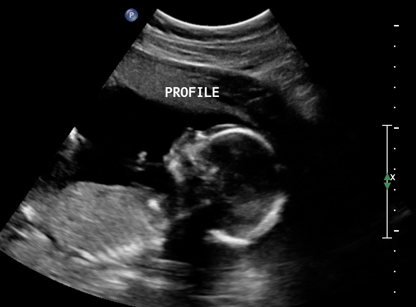 Ultrasound profile