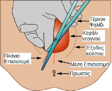 Medio lateral episiotomy