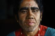 Οικογένεια «λυκανθρώπων» από το Νεπάλ μεταμορφώνεται, κάνοντας λέιζερ για την αφαίρεση τριχοφυίας