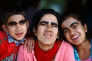 Οικογένεια «λυκανθρώπων» από το Νεπάλ μεταμορφώνεται, κάνοντας λέιζερ για την αφαίρεση τριχοφυίας