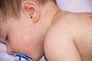 Τροφικές αλλεργίες στα παιδιά: Αίτια, συμπτώματα, θεραπεία