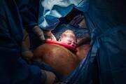 Μωρό βγαίνει από την κοιλιά της μαμάς του -  Πηγή φωτογραφίας: Instagram / monetnicolebirths