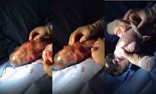 Συγκλονιστικό! Δείτε πώς βγαίνει το μωρό μέσα από τον αμνιακό του σάκο (βίντεο)