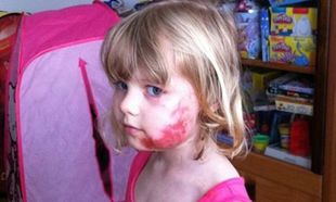 Δεν πάει ο νους σας από τι τραυματίστηκε το 4χρονο κοριτσάκι (φωτό)