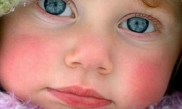 Ποιοι είναι οι λόγοι που ένα μωρό έχει κόκκινα μάγουλα;