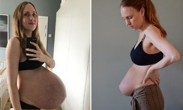 Γέννησε τρίδυμα και μας δείχνει το σώμα της πριν και μετά τη γέννα (pics)