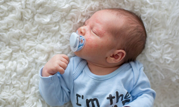Ατοπική δερματίτιδα στα μωρά: Πέντε τρόποι να την αντιμετωπίσετε (pics)