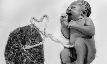 Φωτογραφίες μωρών που γεννιούνται και παραμένουν ενωμένα με τον πλακούντα