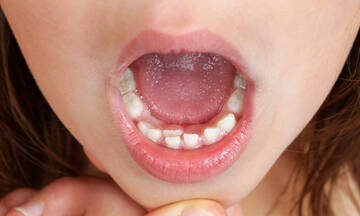 Διπλή σειρά δοντιών στα παιδιά: Τι να κάνετε
