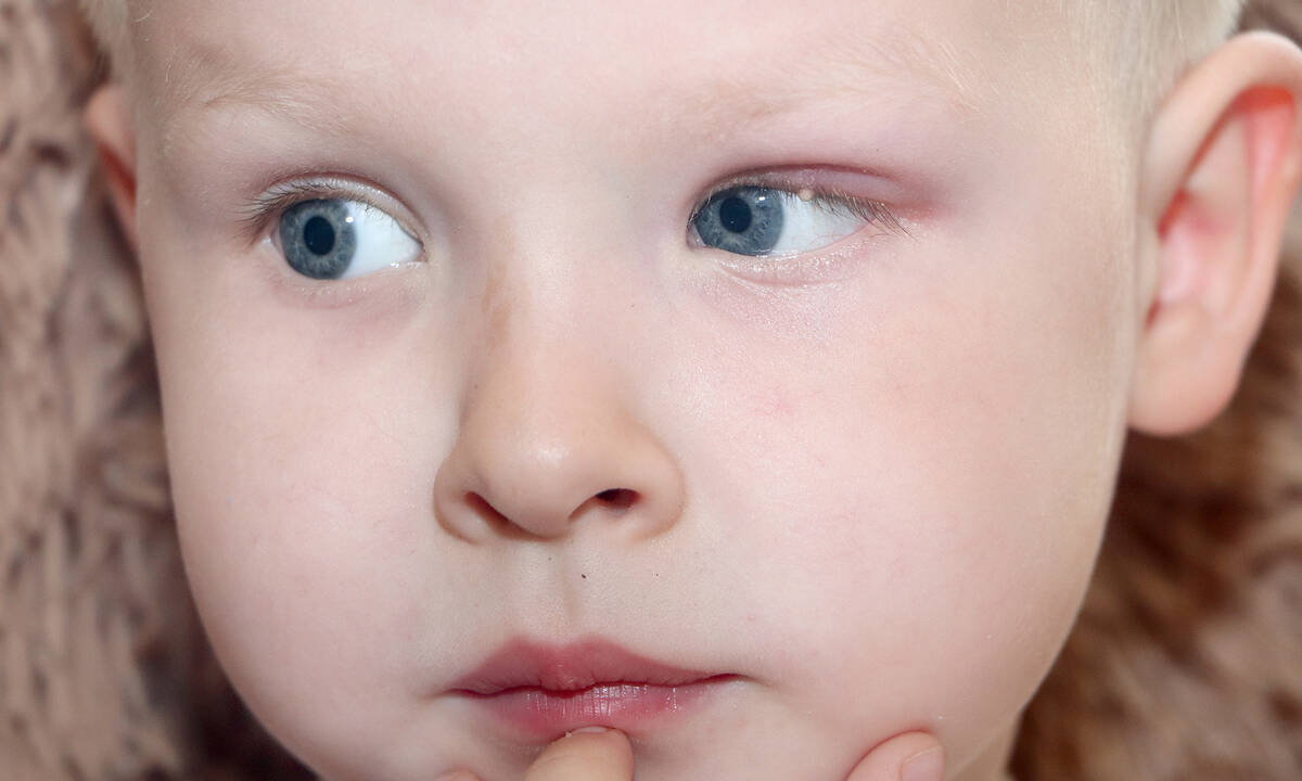 Χαλάζιο και κριθαράκι στα παιδιά: Διαφορές, συμπτώματα και θεραπεία