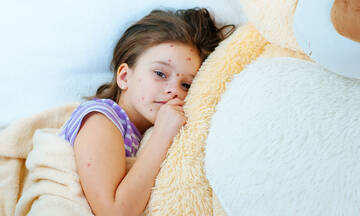  Ανεμοβλογιά στα παιδιά: Τα συμπτώματα και οι διαφορές από την ευλογιά των πιθήκων